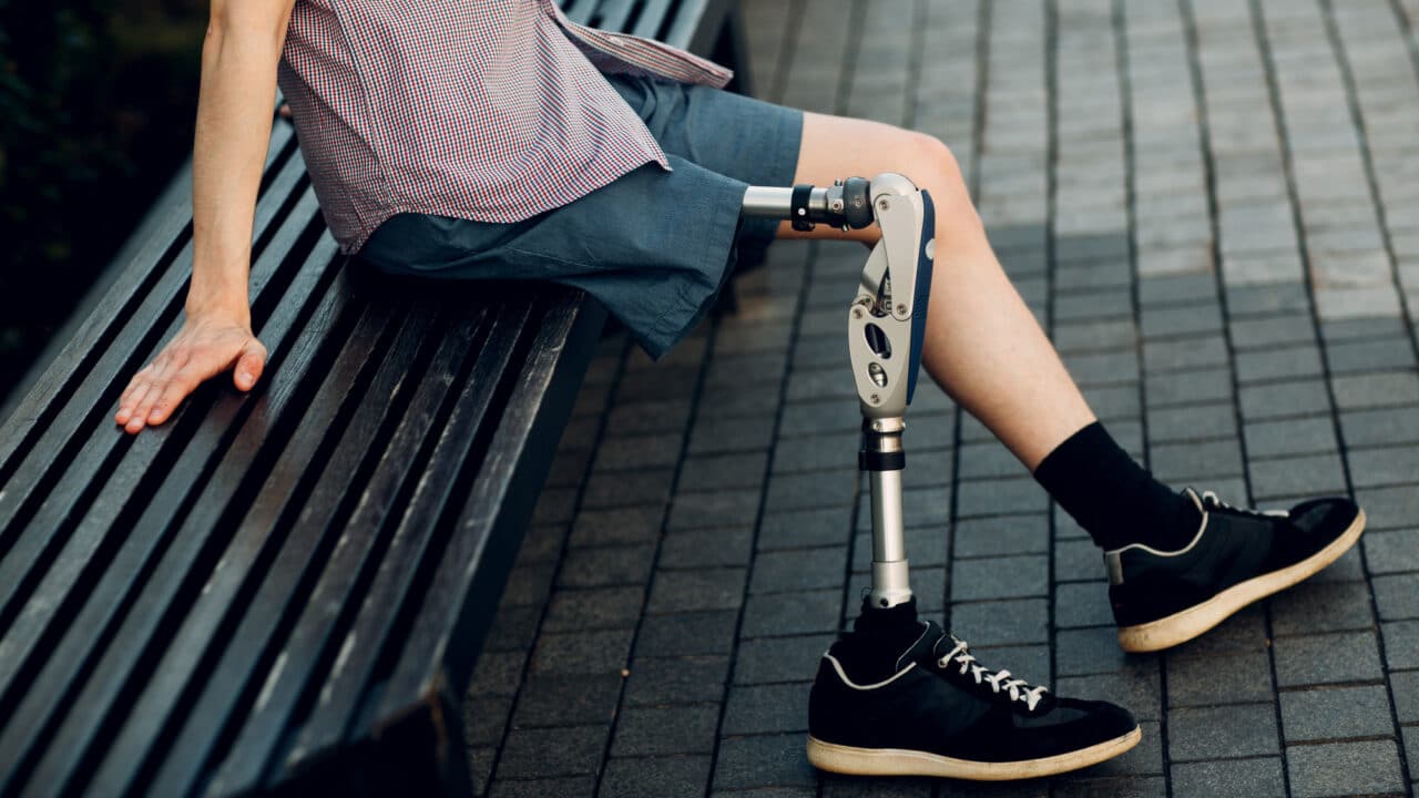 Schmerzensgeld bei Beinamputation: Ansprüche, Bemessung und Durchsetzung