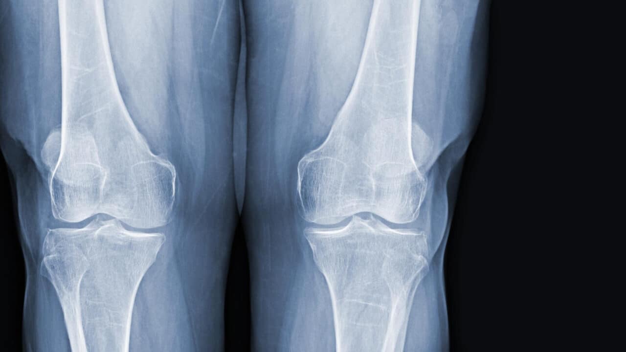 Schmerzensgeld beim Oberschenkelhalsbruch: Was Patienten wissen müssen